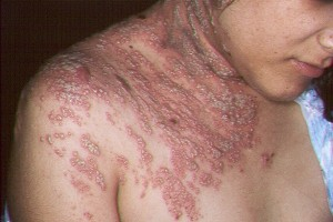 Illustration for article titled Cara Menghilangkan Penyakit Herpes Zoster